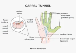 CARPAL TUNNEL SYNDROME