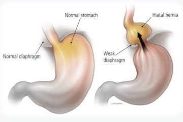 HERNIA HIATAL HERNIA HIATAL
