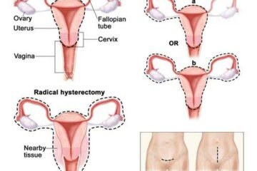 HISTERECTOMÍA ABDOMINAL HISTERECTOMÍA ABDOMINAL
