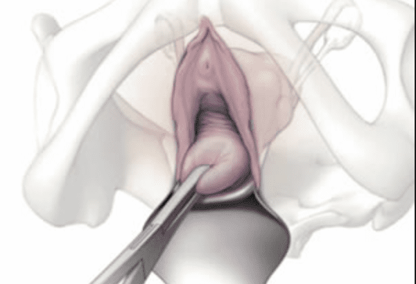 SALPINGOOFORECTOMIA (CIRUGÍA DE EXTIRPACIÓN DE OVARIOS) – Cirugía