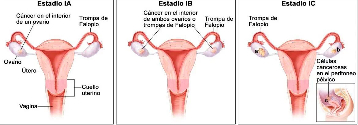 A la extirpación quirúrgica de uno o ambos ovarios se le llama